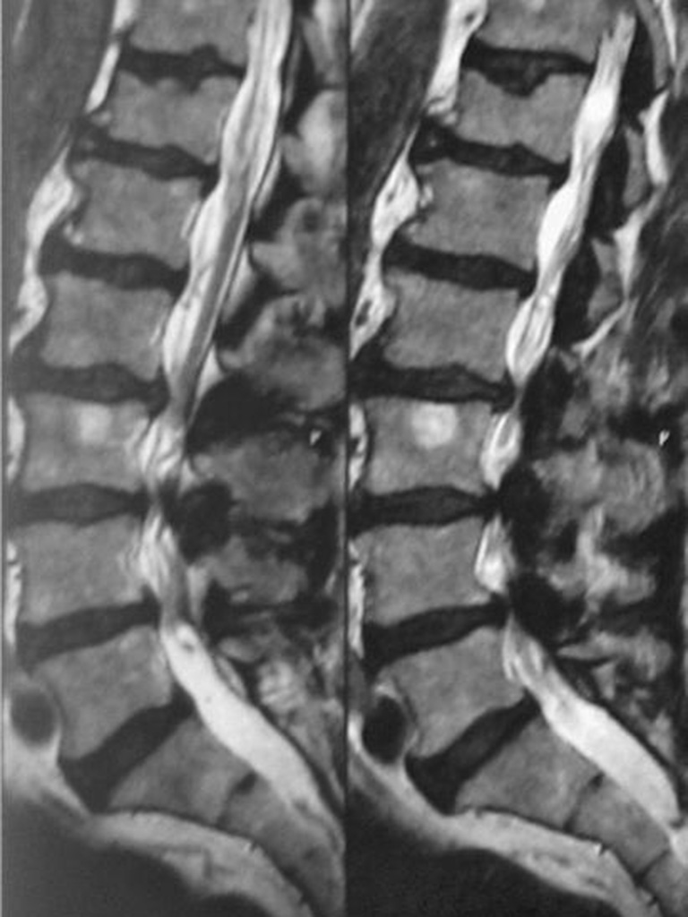 Stenose sagittal Stenose sagittal