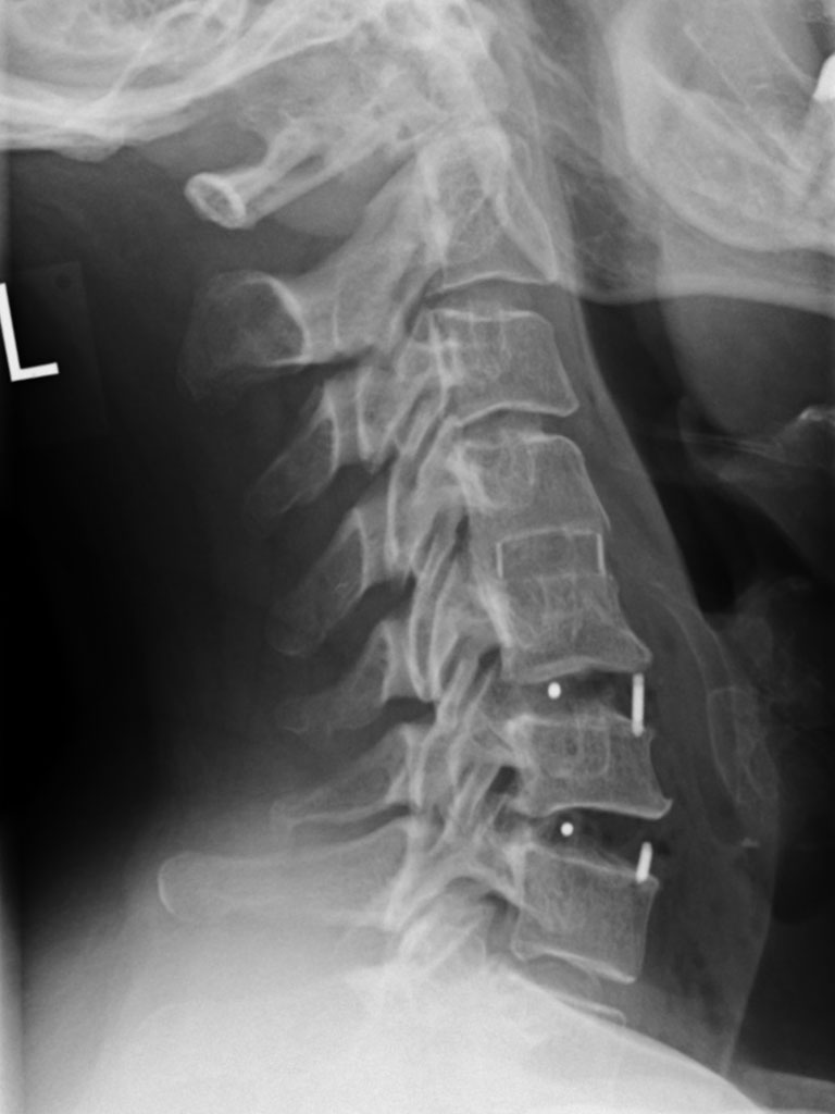 Rontgen-HWs-nach-Fusion-3-Hohen
