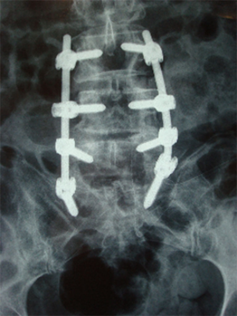 Roentgen 3 Hoehen spondylodese