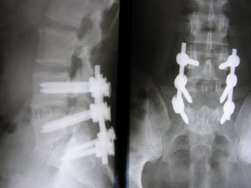 Roentgen 2 Hoehen Spondylodese