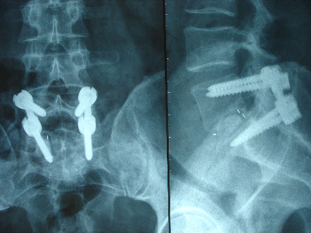 Roentgen Spondylodese L5-S1